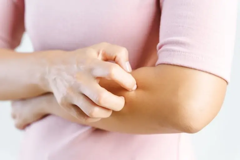 itchy skin close up woman scratching arm