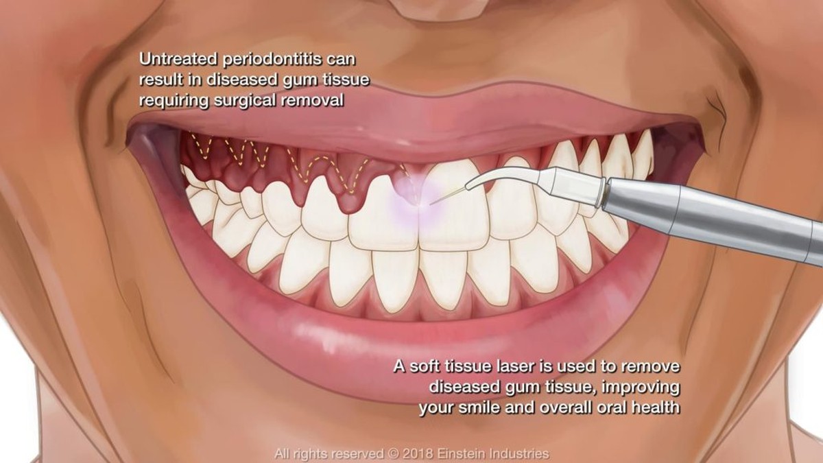 Kaugummi im Teppich? Salzeis löst es in 10 Sekunden - image 1